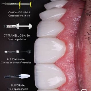 Foto do canal Facetas de resina e de porcelana, de Cursos